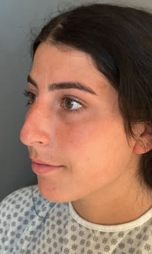 Septorhinoplasty – before surgery showing patient’s nose from the front view