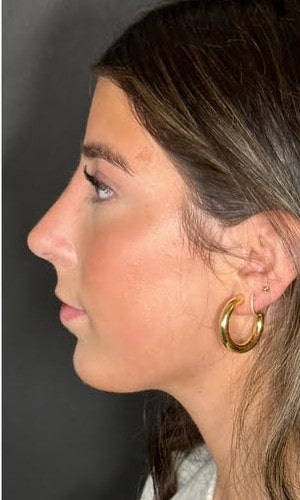 Septorhinoplasty – after surgery side profile showing smoother nasal bridge and refined tip