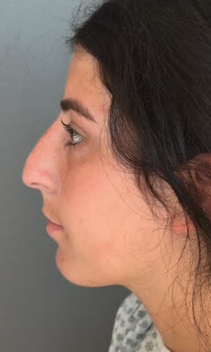 Septorhinoplasty – before surgery showing patient’s nose profile with bridge concerns