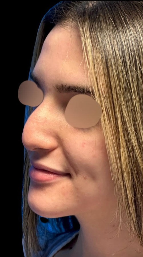 Septorhinoplasty – 3 months after surgery showing early results of refined and lifted tip from the front