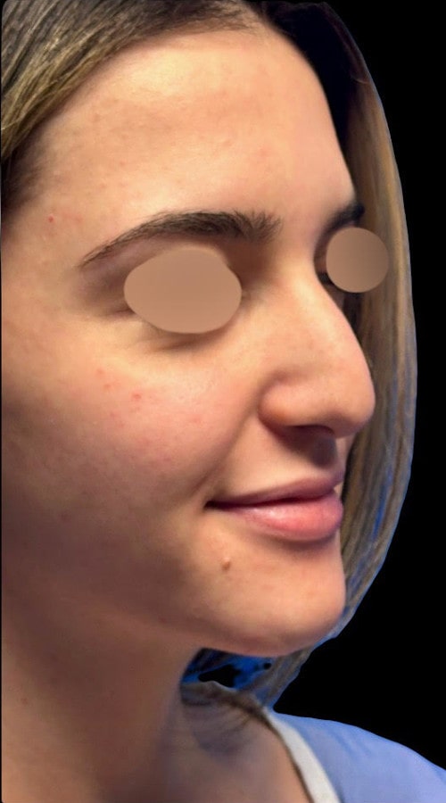 Septorhinoplasty – 3 months after surgery showing side profile with lifted and refined tip