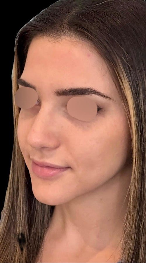 Septorhinoplasty – three months post-op front view showing early results of refined and balanced tip