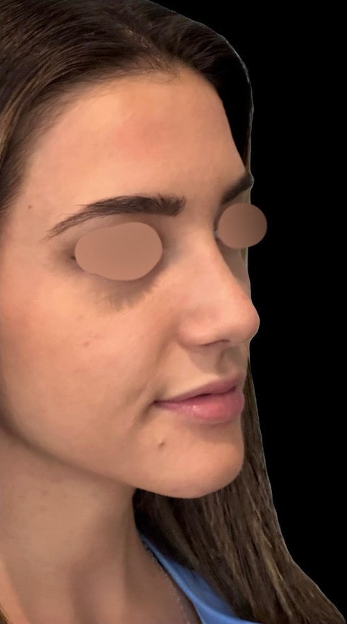 Septorhinoplasty – three months post-op side profile showing improved tip and nasal shape