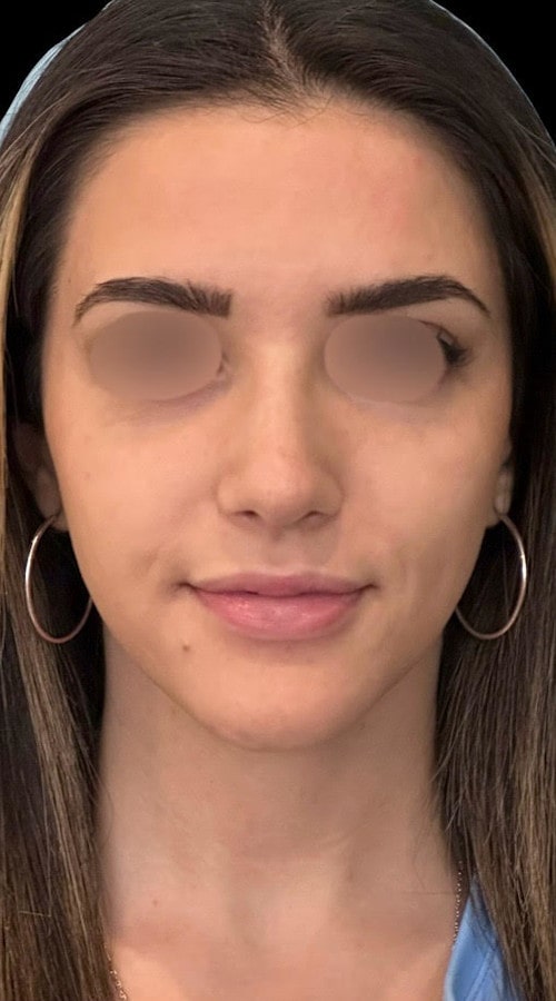 Septorhinoplasty – after surgery front view showing refined nasal bridge and lifted tip