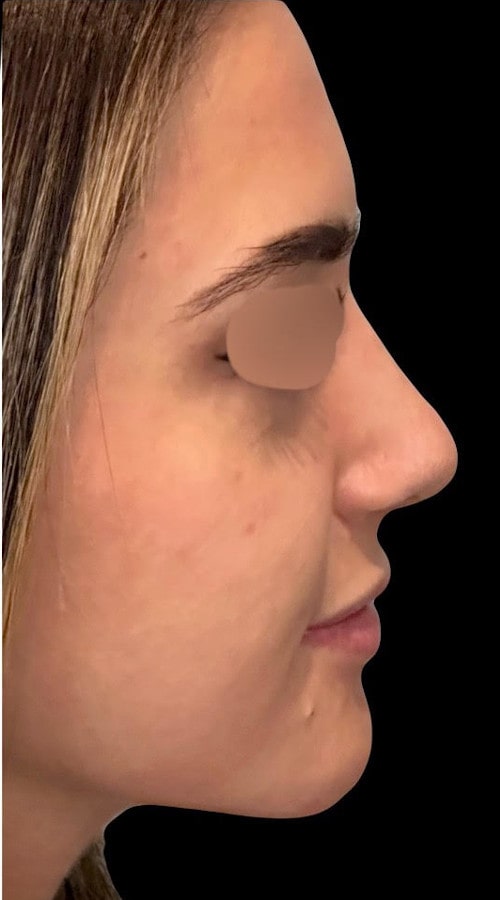 Septorhinoplasty – after surgery side profile showing improved nasal contour and tip refinement
