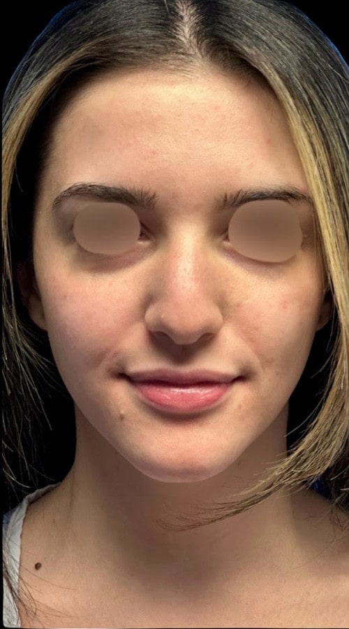 Septorhinoplasty – before surgery showing patient’s nose from the front with prominent bridge and tip