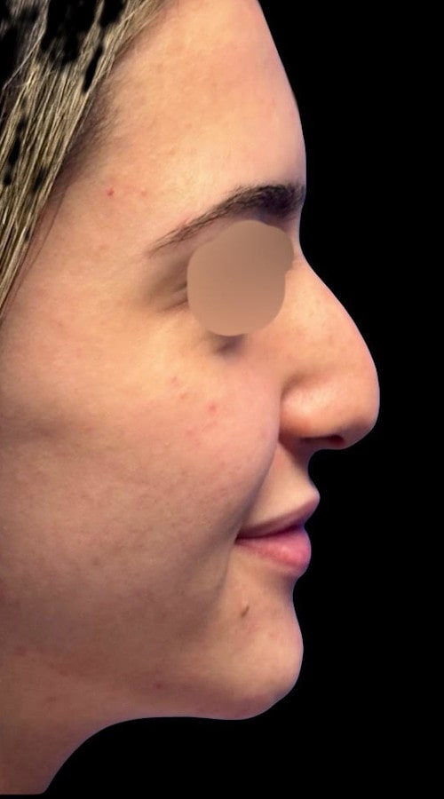 Septorhinoplasty – before surgery showing side profile of the nose with prominent bridge and tip