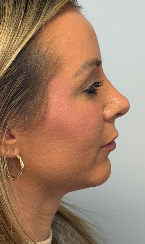 Rhinoplasty – three months post-op side profile showing lifted tip and smooth bridge