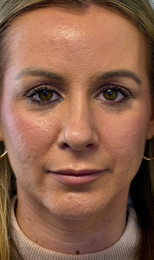 Rhinoplasty – six months after surgery front view showing refined tip and balanced nasal bridge
