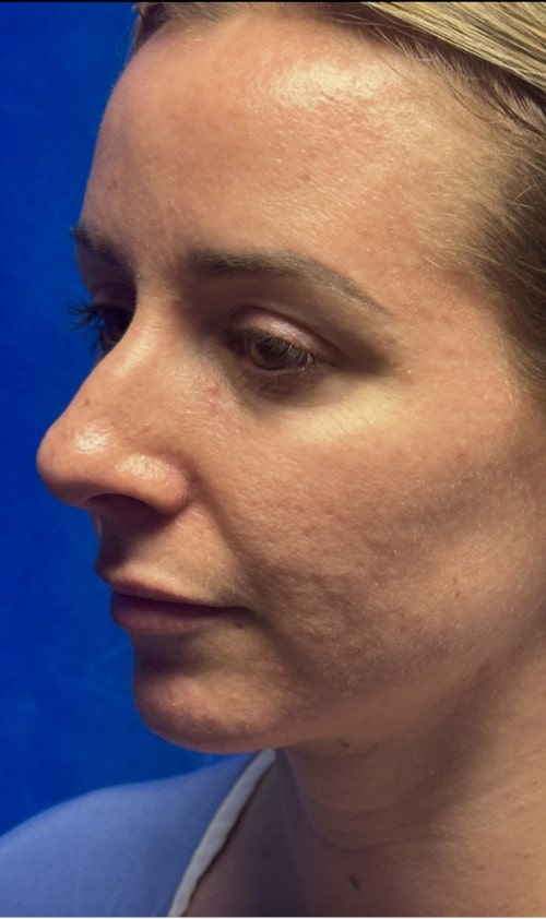 Rhinoplasty – three months after surgery front view showing early results of refined tip and soft bridge curve