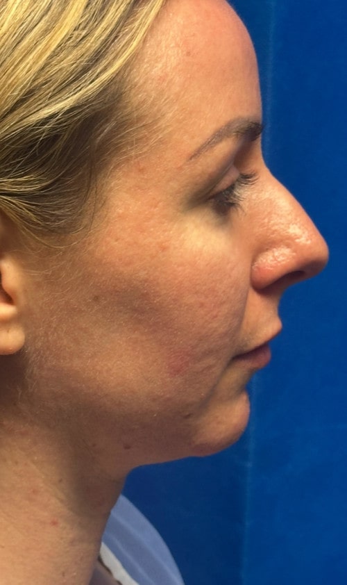 Rhinoplasty – three months after surgery side profile showing early tip refinement and soft bridge curve