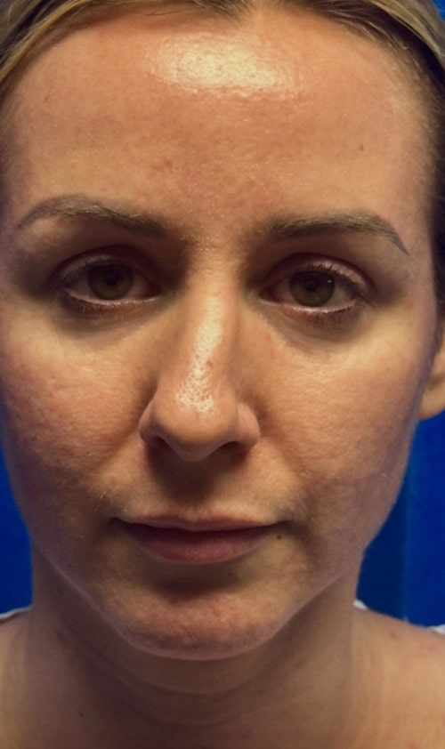 Rhinoplasty – before surgery front view showing patient’s nose with prominent bridge and droopy tip