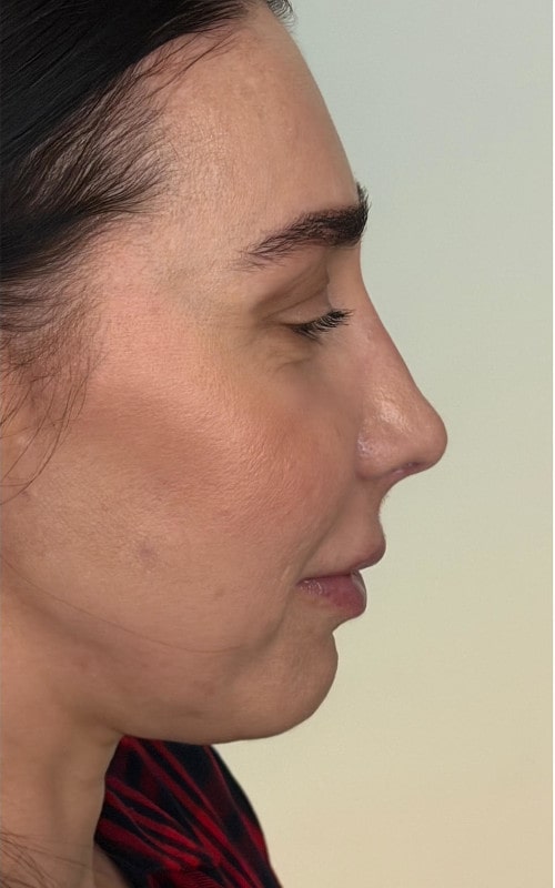 Rhinoplasty – three months post-op side profile showing smoother dorsum and lifted nasal tip