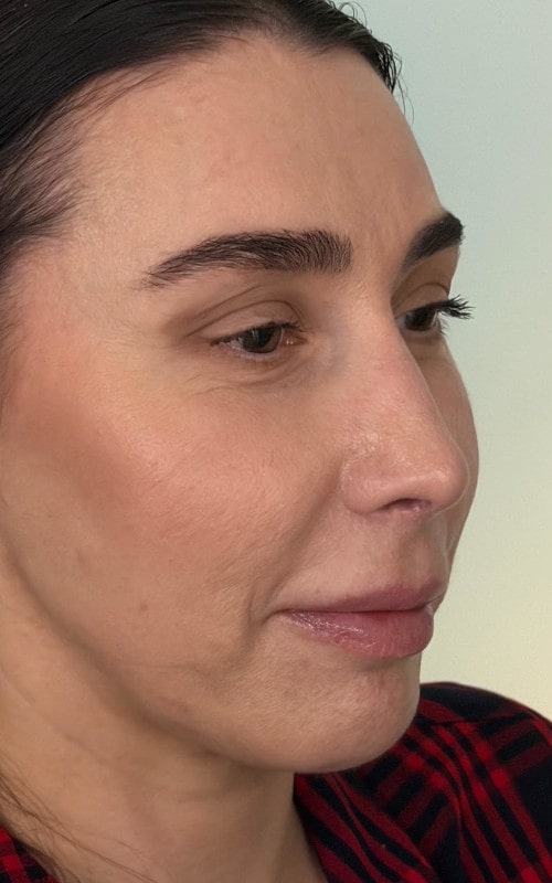 Rhinoplasty – post-operative close-up showing refined nasal tip and smooth bridge contour