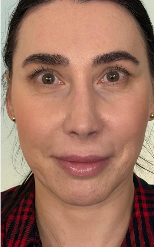 Rhinoplasty – post-surgery front view showing refined nasal tip and smoother bridge