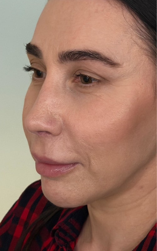 Rhinoplasty – post-surgery oblique view showing refined nasal contour and improved symmetry