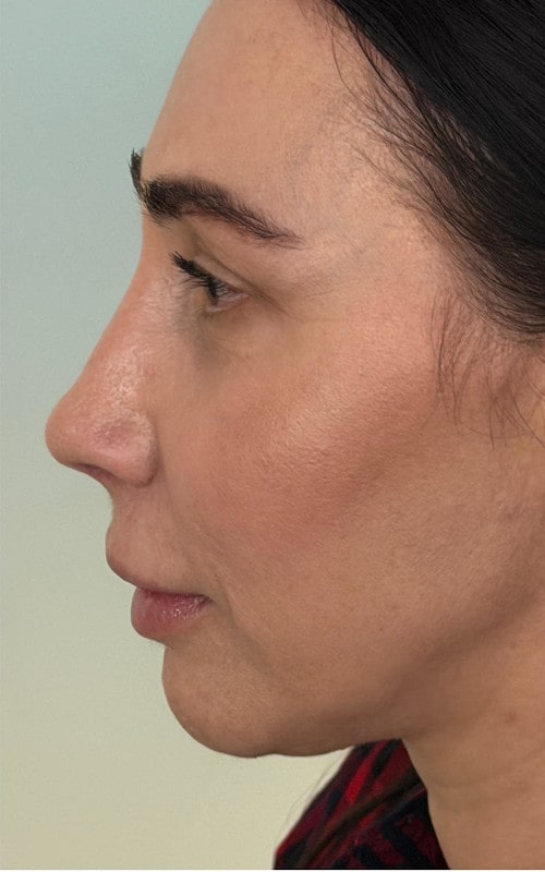 Rhinoplasty – post-surgery side profile showing smooth dorsal line and lifted nasal tip