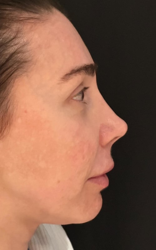 Rhinoplasty – three months post-op early side view showing reduced bridge and improved tip position