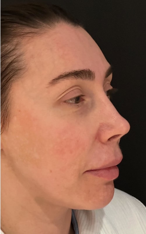 Rhinoplasty – pre-operative close-up view showing tip bulbosity and bridge prominence