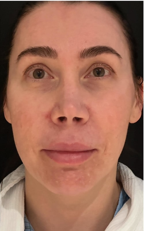 Rhinoplasty – before surgery front view showing nasal bridge fullness and tip heaviness