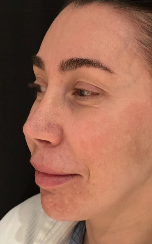 Rhinoplasty – before surgery oblique view showing nasal asymmetry and broad tip