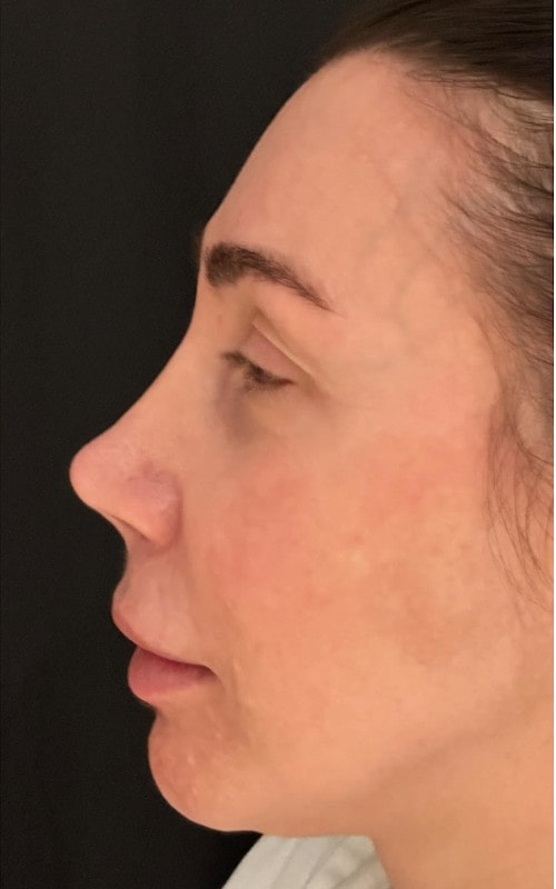 Rhinoplasty – before surgery side profile showing dorsal hump and tip projection