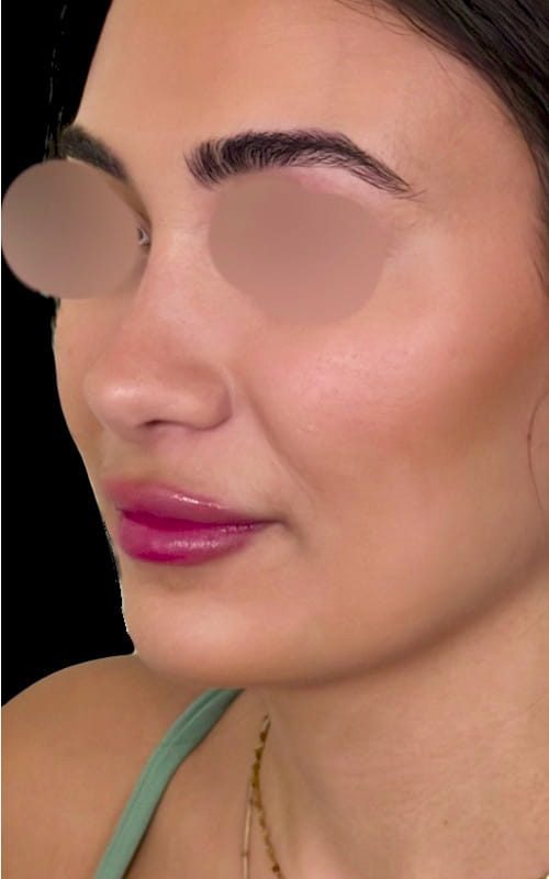 Rhinoplasty – one year post-surgery front view showing refined tip, reduced bridge, and gentle curved profile