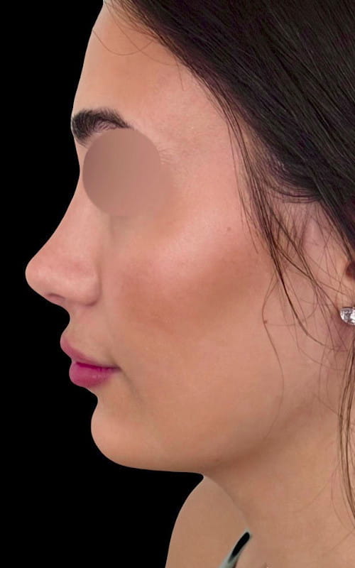 Rhinoplasty – one year post-surgery side profile showing lifted tip, smooth bridge, and more curved profile