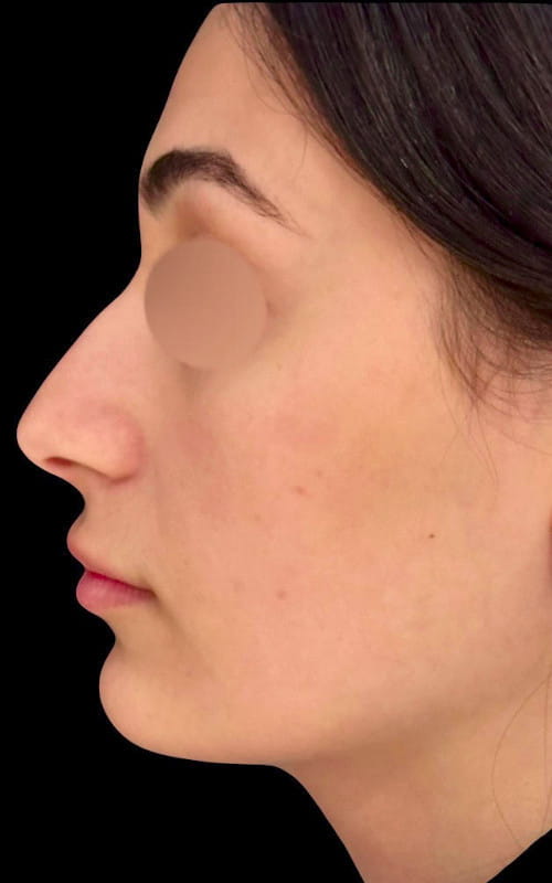 Rhinoplasty – before surgery side profile showing dorsal hump and less defined tip