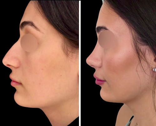 Rhinoplasty Case 114 – One-Year Results with Curved Profile and Refined Tip