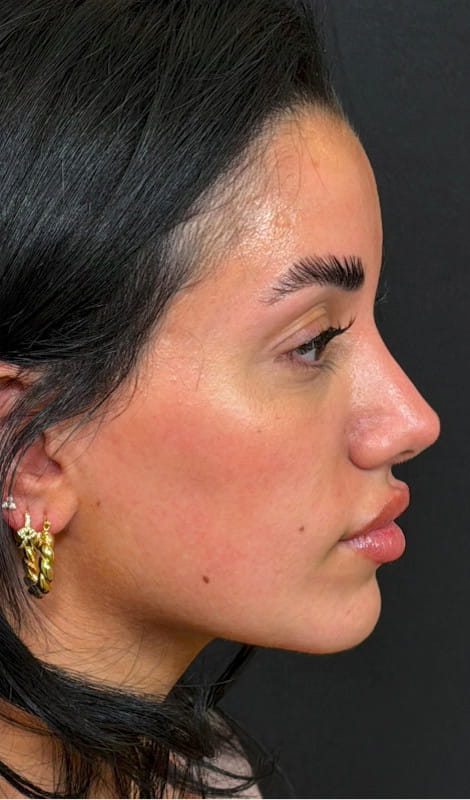Rhinoplasty – 18 months post-operative close-up showing smooth bridge and refined nasal tip