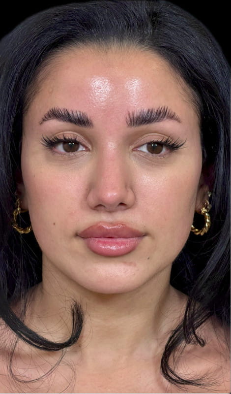 Rhinoplasty – 18 months post-surgery front view showing refined nasal tip and smoother bridge