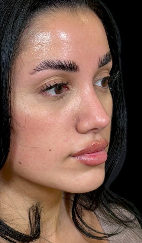 Rhinoplasty – 18 months post-surgery oblique view showing refined nasal contour and improved balance