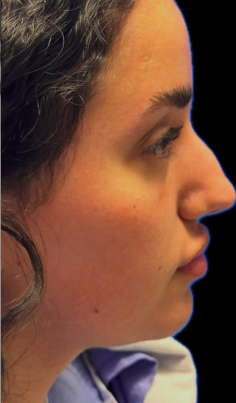 Rhinoplasty – pre-operative close-up view showing nasal bump and less refined tip