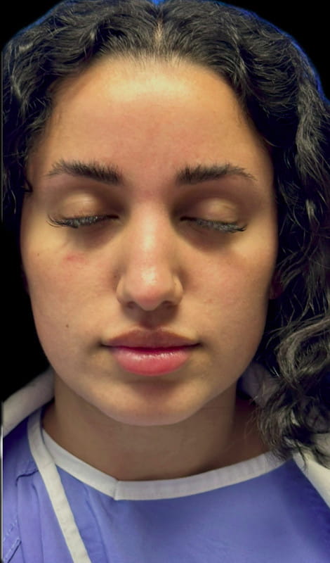 Rhinoplasty – before surgery front view showing nasal bridge bump and less defined tip