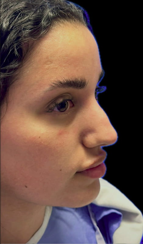 Rhinoplasty – before surgery oblique view showing bridge prominence and limited tip definition