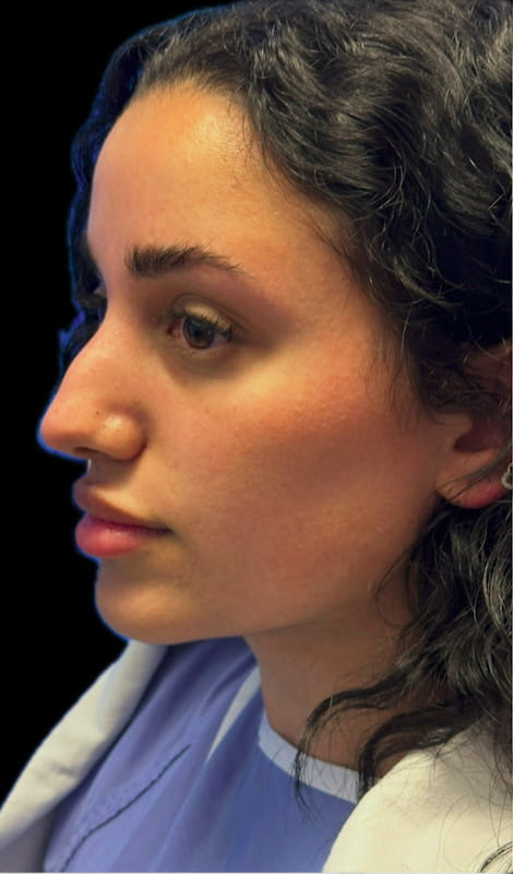 Rhinoplasty – before surgery side profile showing dorsal hump and mild tip droop