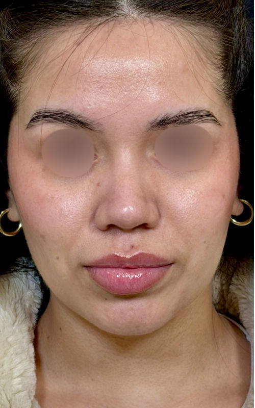 After rhinoplasty front view showing a straighter bridge, refined tip definition, and a more balanced nasal appearance.