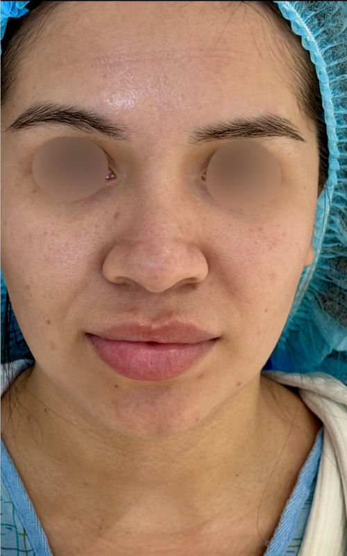 Before rhinoplasty front view showing a wider bridge, fuller nasal tip, and less defined nose shape.