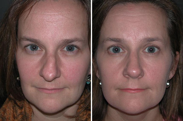 Revision Rhinoplasty