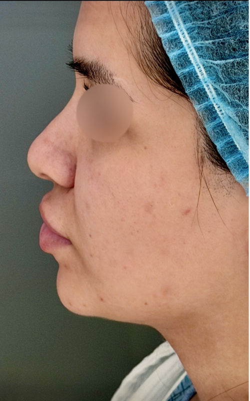 Before rhinoplasty side profile showing a prominent nasal hump, drooping tip, and fuller nose shape.