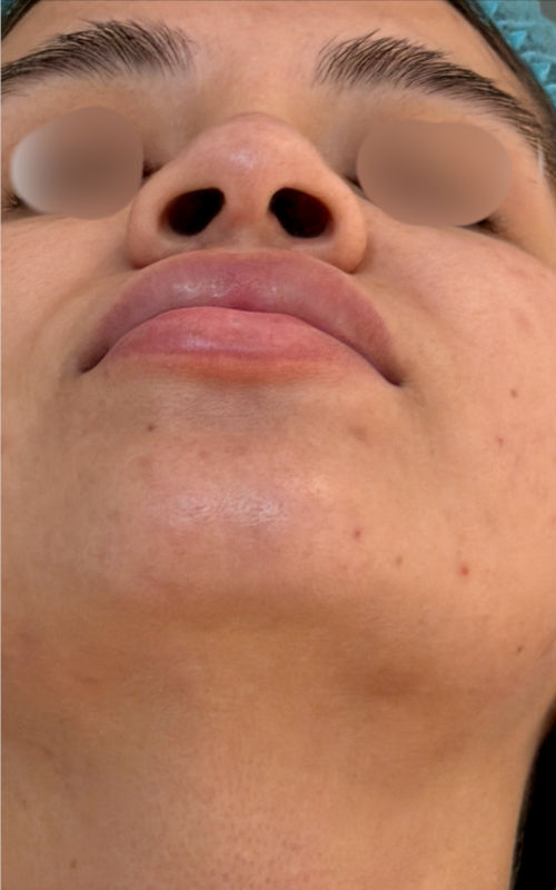 Before rhinoplasty underside view showing a broader nasal tip, wider nostrils, and less tip definition.