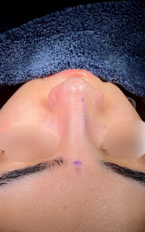 After rhinoplasty front view showing a straighter bridge, improved tip symmetry, and more balanced nostrils.