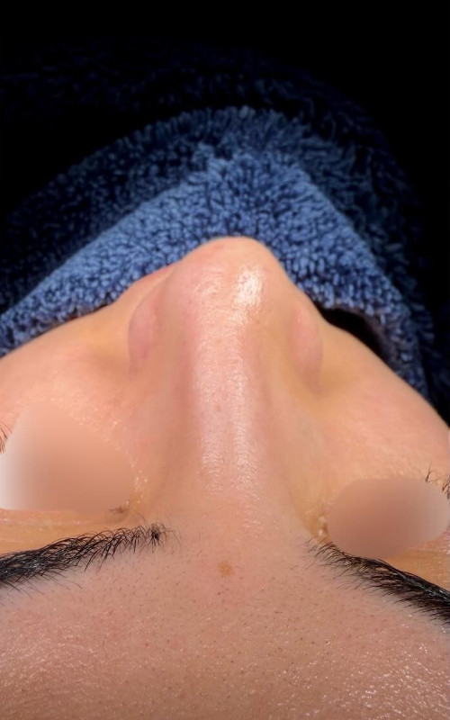 Before rhinoplasty front view showing a crooked nasal bridge, asymmetrical tip, and uneven nostrils.