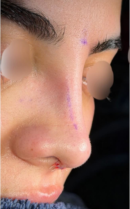 After rhinoplasty lower front view showing improved nostril balance, refined tip shape, and better nasal alignment
