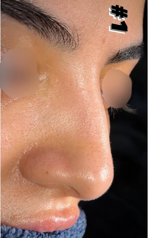 Before rhinoplasty lower front view showing nostril asymmetry, tip imbalance, and a crooked nasal base.