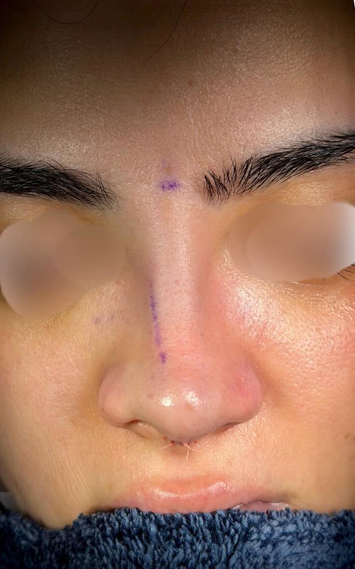 After rhinoplasty side profile showing a smoother nasal bridge, refined tip, and more balanced profile.