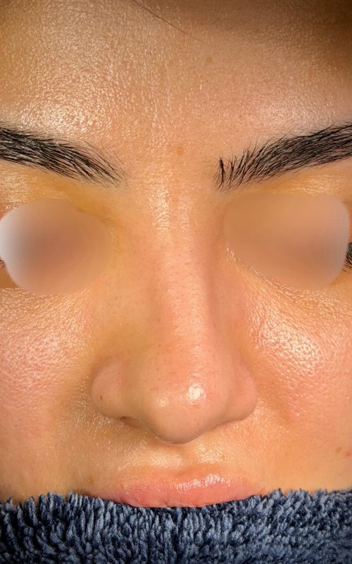 Before rhinoplasty side profile showing a small dorsal bump, fuller nasal tip, and slightly uneven nasal contour.