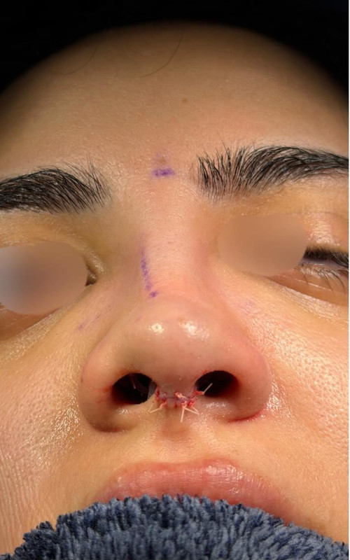 After rhinoplasty underside view showing improved nasal symmetry, more even nostrils, and a straighter septum.