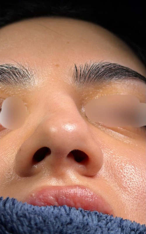 Before rhinoplasty underside view showing nasal asymmetry, uneven nostrils, and a deviated septum.